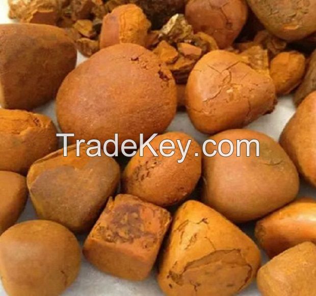 gallstone