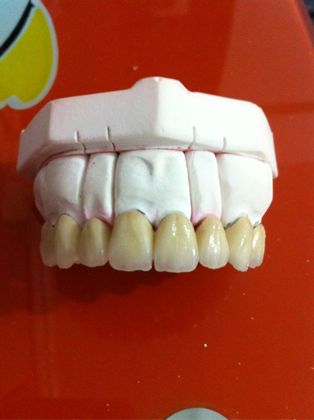 Zirconia crown/bridge/denture/dental restorations/dental supplies