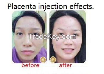 Human Placenta Injections Human Placental Tissue fluid