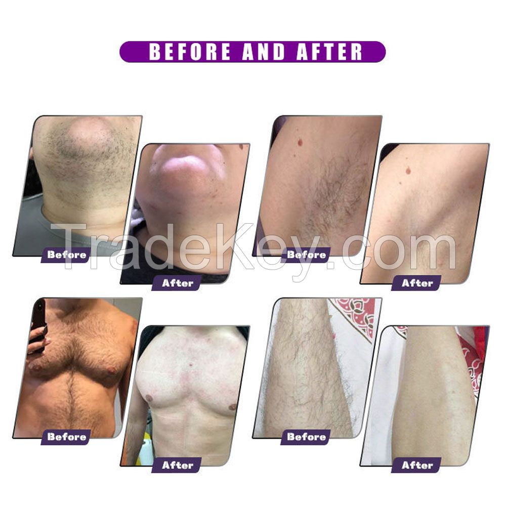 808nm diode laser hair removal machine 