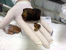 CT of gallstones