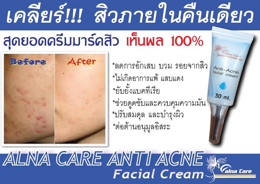 Alna care Anti Acne Facial Cream