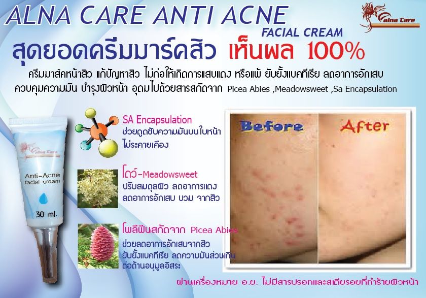 Alna care Anti Acne Facial Cream