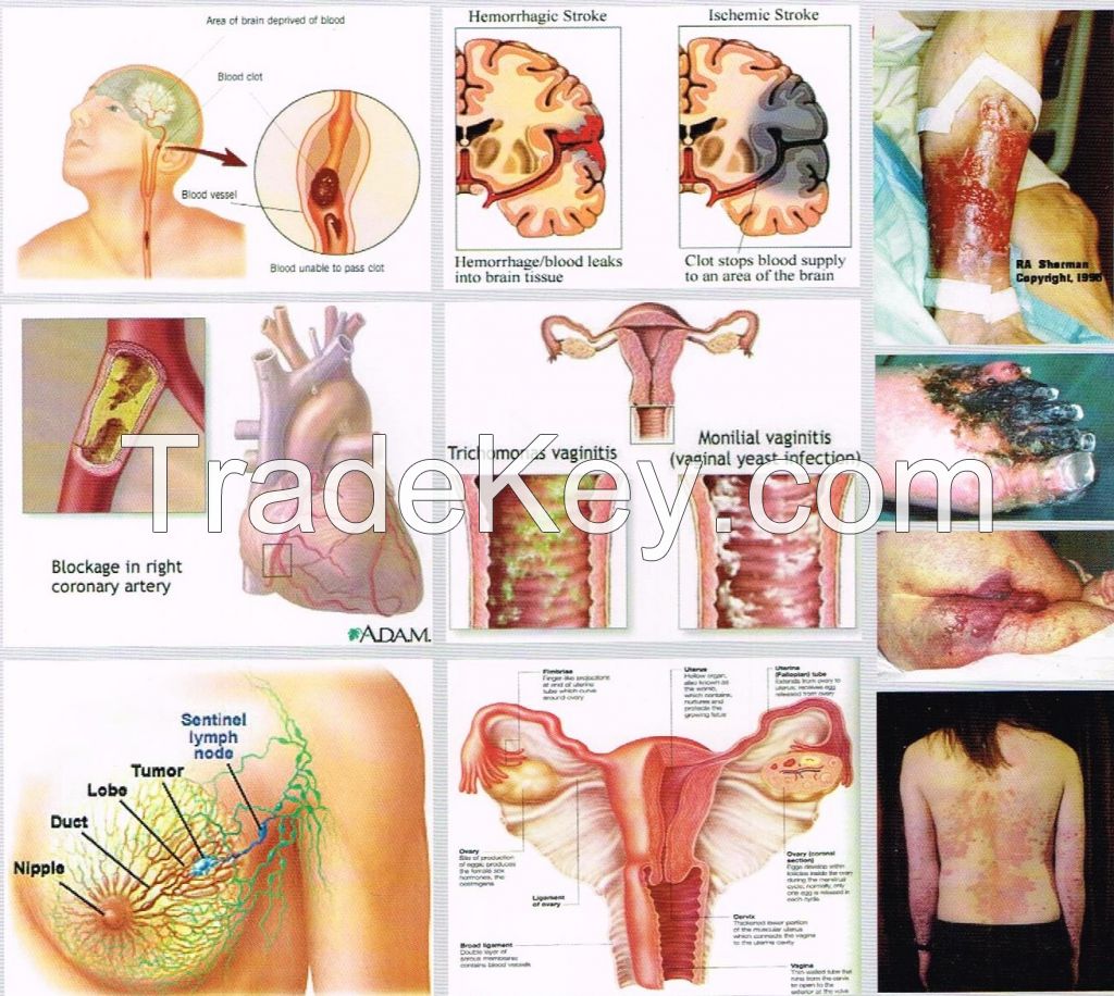 Ozone Therapy 