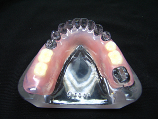 Valplast denture