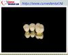 High yellow gold PFM c...