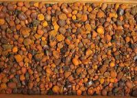 Gallstones