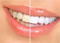 PERALAS-  For Teeth Whitening/  / Pain Therapy