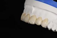 Full Zirconia Crowns