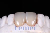 Custom Zirconia Crowns