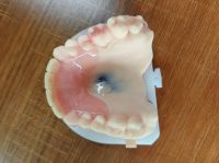 Valplast Denture