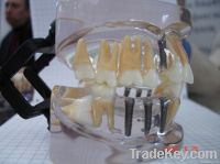 Transparent  Implantdisease Model Model/transparent Jaw
