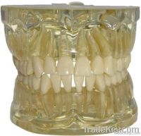 Transparent Tooth Extraction Model/transparent Jaw