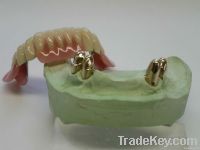 Dental telescope crown