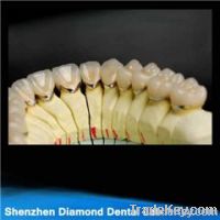 Dental Precious pfm crown and bridge